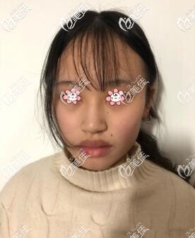 术前我的嘴巴 术前我的嘴巴