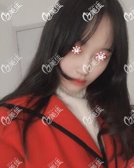 <!--<i data=20240703-sp></i>-->厚唇改薄术后一个月 <!--<i data=20240703-sp></i>-->厚唇改薄术后一个月