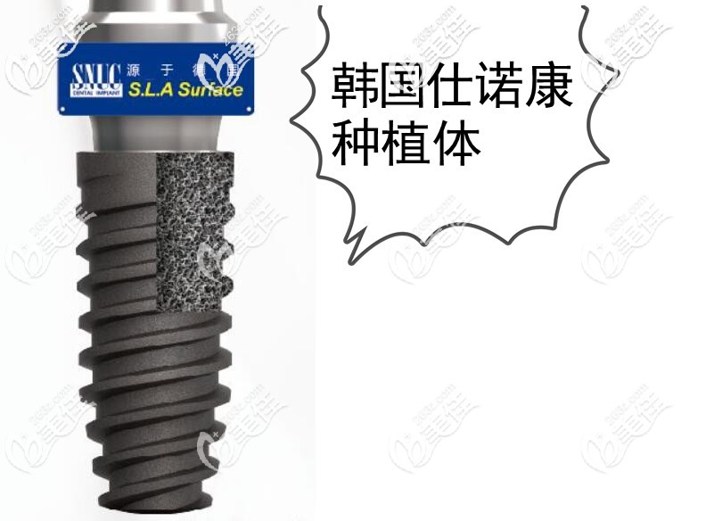 仕诺康种植体怎么样,好不好 仕诺康种植体怎么样,好不好