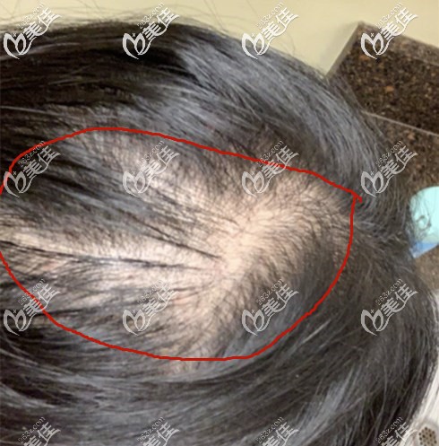 本身头发就比较稀疏,头发缝还变大了 本身头发就比较稀疏,头发缝还变大了