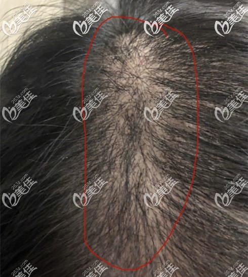 头发加密种植1500单位图片 头发加密种植1500单位图片