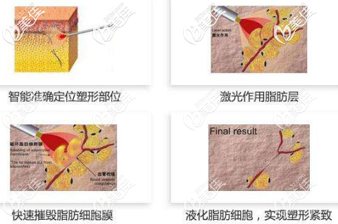 激光溶脂的过程 激光溶脂的过程