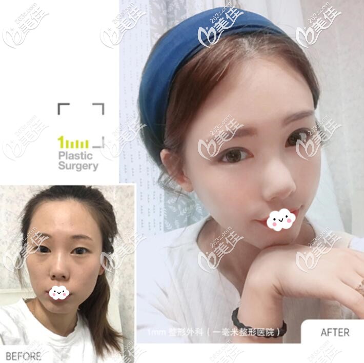 韩国1mm整形除了双眼皮手术好，面部轮廓也不赖