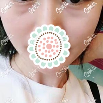 王女士两年前有眼袋的样子 王女士两年前有眼袋的样子