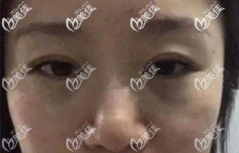 做去眼袋手术后一周可以正常工作 做去眼袋手术后一周可以正常工作