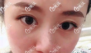 割眼袋两周后的效果 割眼袋两周后的效果