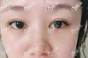 30岁的王女士在做内切去眼袋手术二年后来说术后没复发也没塌陷