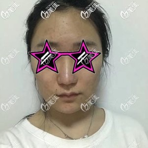 做手术前自己下垂的面部 做手术前自己下垂的面部