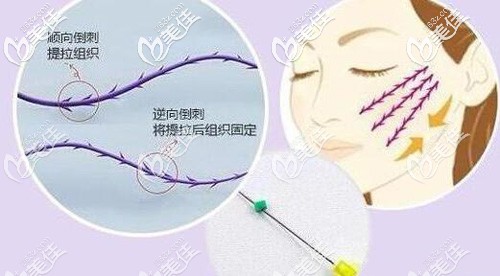 医生给出的埋线提升手术原理 医生给出的埋线提升手术原理