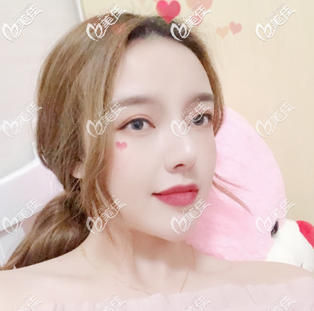 广州美莱面部吸脂术后45天效果