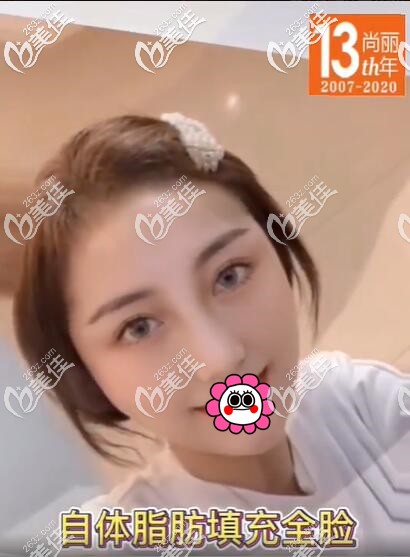 自体脂肪面部填充术后两个月