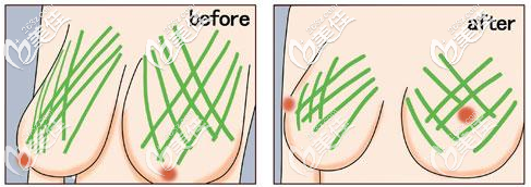 不开刀人工韧带提胸效果图