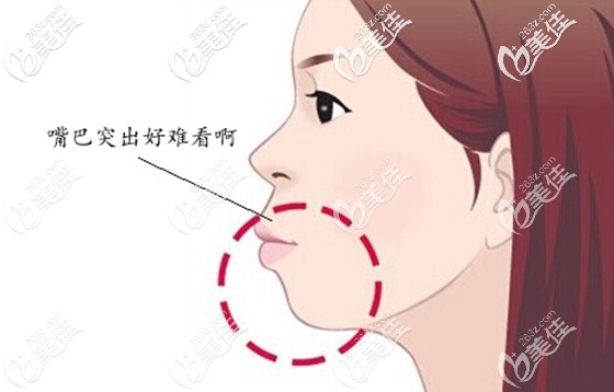 女朋友的轻微龅牙好难看