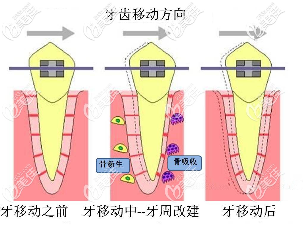 牙齿改建移动的规律