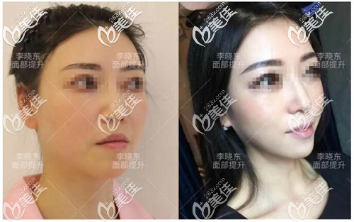 李晓东医生pst面部提升案例 李晓东医生pst面部提升案例