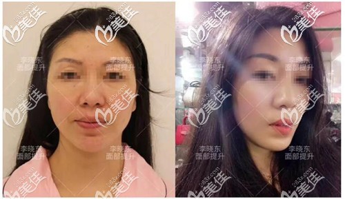 pst面部提升真实真人案例 pst面部提升真实真人案例