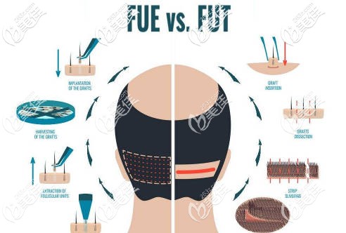 FUE和FUT植发技术过程演示