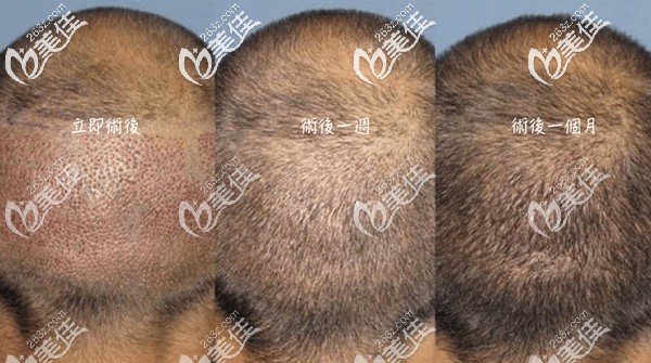 植发后后枕部的恢复过程图