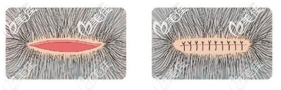 FUT植发手术会在后枕部留疤