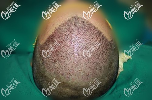 前额头顶种植术后即刻效果