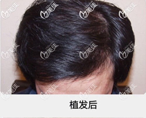 讲述我去广州壹加壹做头顶植发的亲身经历,花了三万多的价格,效果怎样你们来看!