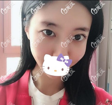 双眼皮修复术前照 双眼皮修复术前照