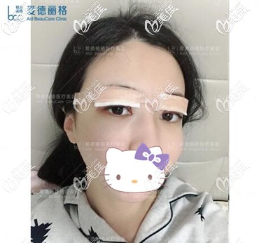 大连双眼皮修复术后当天照 大连双眼皮修复术后当天照