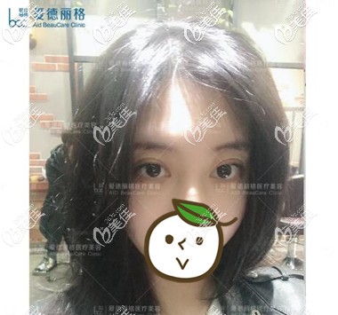 在大连修复双眼皮术后第5天照 在大连修复双眼皮术后第5天照