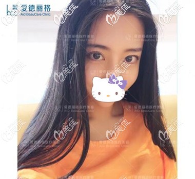 双眼皮失败修复术后半个月效果照 双眼皮失败修复术后半个月效果照