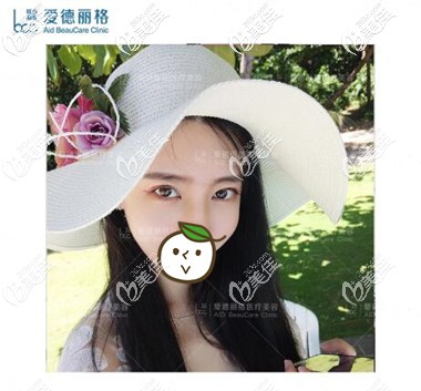 埋线双眼皮失败修复术后1个月照 埋线双眼皮失败修复术后1个月照