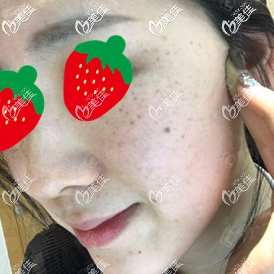 这是刚做完皮秒拍的照 这是刚做完皮秒拍的照