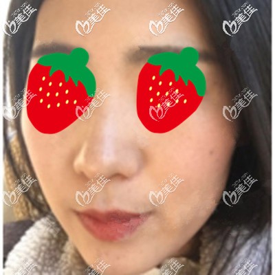 皮秒祛斑术后半个月照片 皮秒祛斑术后半个月照片