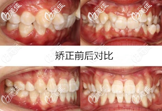 这是我一个26岁老阿姨在义乌傅氏口腔做深覆盖牙齿矫正的案例哦，有没有和我一样矫正后像垫下巴的？