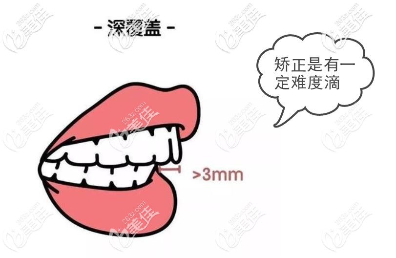 深覆盖矫正难度大不大 深覆盖矫正难度大不大