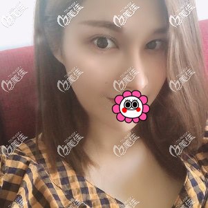 肋软骨隆鼻恢复一个月<span style=