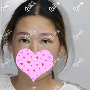 全切双眼皮术后即刻未包扎