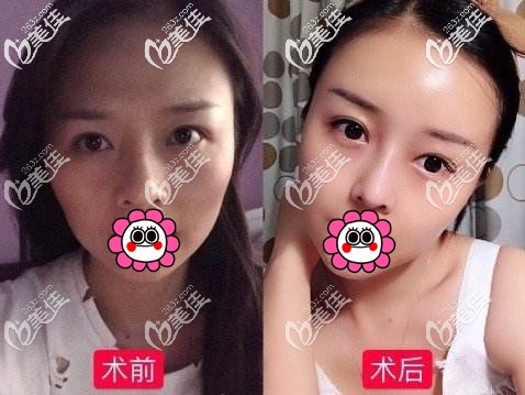 自体脂肪面部填充效果对比图