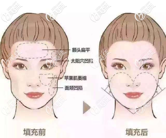 面部容易凹陷部位示意图