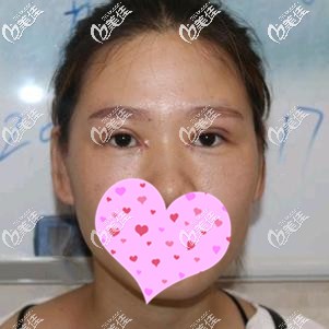 切开双眼皮+开眼角术后7天拆线