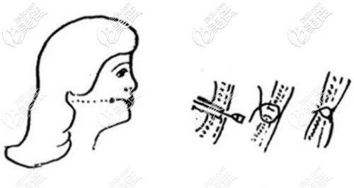 埋线酒窝成形术原理 埋线酒窝成形术原理