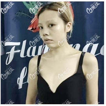 找许扬滨做隆胸术前照片 找许扬滨做隆胸术前照片