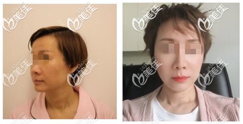 pst面部提升案例 pst面部提升案例
