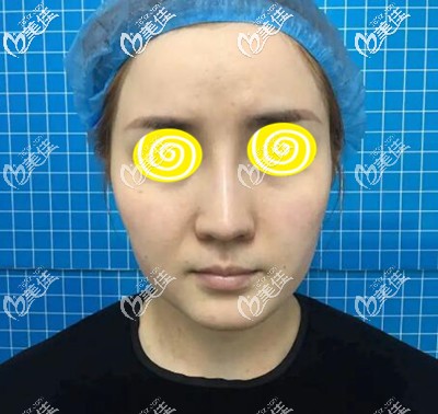 做面部自体脂肪填充术前照 做面部自体脂肪填充术前照