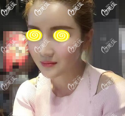 面部自体脂肪移植填充术后17天效果照 面部自体脂肪移植填充术后17天效果照