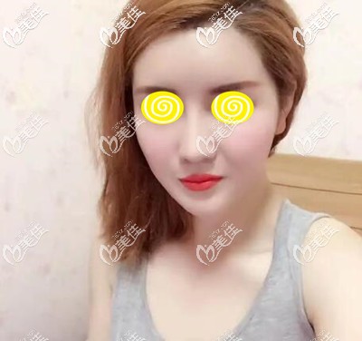 面部自体脂肪移植填充术后33天效果照 面部自体脂肪移植填充术后33天效果照