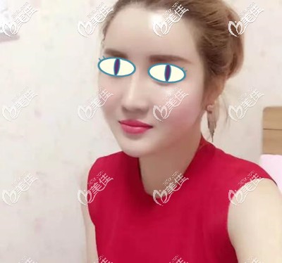 得知大连自体脂肪填充哪家医院做的好后我找关世超做了面部填充手术，给大家看下2个月的恢复效果！