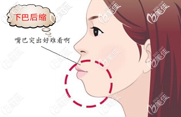 下巴后缩+凸嘴怎么改善