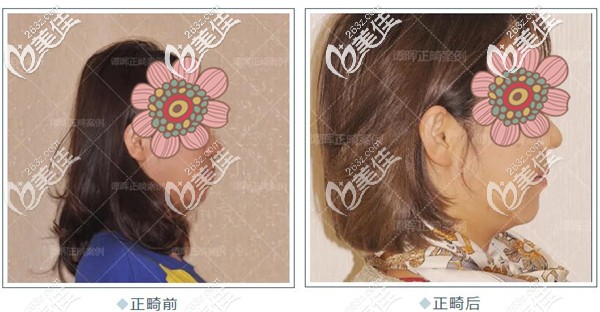 下巴后缩在北京维乐口腔做矫正的效果