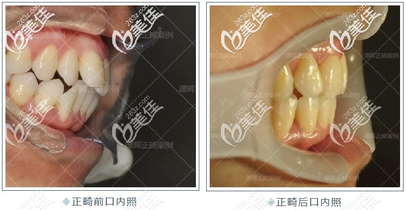 30岁老阿姨凸嘴+下巴后缩,在北京戴金属自锁牙套矫正后的效果肉眼可见哦