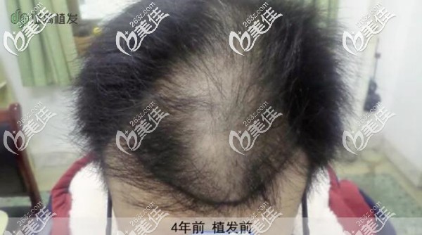 4年前植发前头顶头发稀疏 4年前植发前头顶头发稀疏